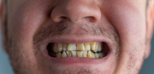 Difficulty cleaning between teeth